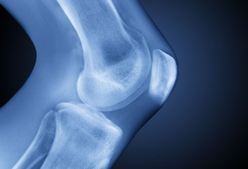 Arthrosis is a degenerative disease that affects people of advanced age