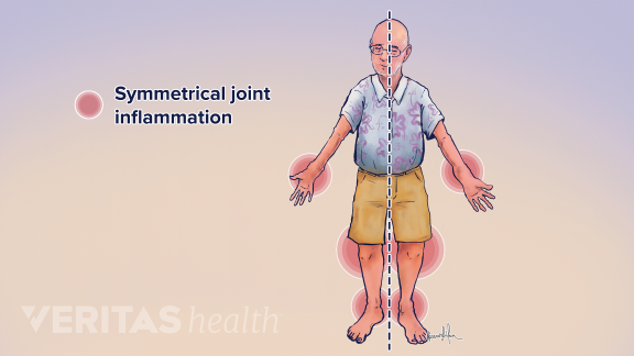 Rheumatoid arthritis is one of the types of arthritis