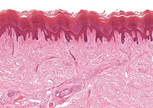 Cross section of the skin seen under a microscope. The epidermis is the darkest part (the outermost horny layer is peeling off) and the dermis is the lightest.