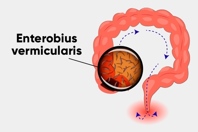 Az enterobiosis forrása. Oxyuriasis, Az enterobiasis forrása