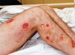 Wounds caused by botulism