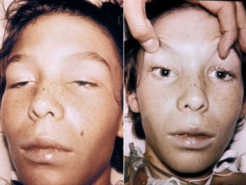 Young man with botulism