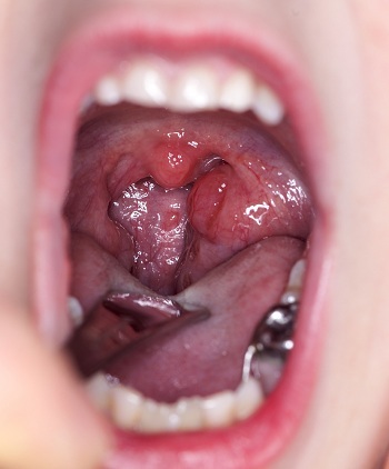 Tonsillitis, inflammation of the tonsils or tonsils, has the same symptoms as pharyngitis