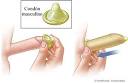 How to use the male condom