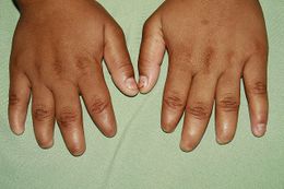 It is characterized by nail abnormalities ranging from onychodystrophy (dystrophic nails) to anonychia (absence of nails)