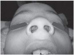 Collection of pus between the mucoperichondrium and the cartilage of the nasal septum