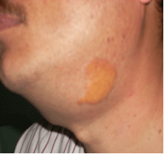 Inflammation of infectious origin of the parotid gland.