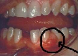Painful acute inflammatory lesion, located at the level of the papilla or the marginal gingiva.