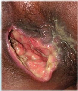 Perianal abscess