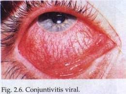 Ophthalmological conditions