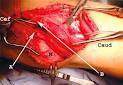 The popliteal artery is an artery that originates as a prolongation of the femoral artery.