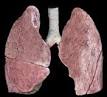 It is an inflammatory disease that selectively affects the bronchioles and presents with an obstructive picture of the airways of rapid onset.