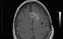 They are a form of glioma with star-shaped cells . Often and for long periods they grow very slowly or not at all. Therefore, a close observation rather than a treatment is possible in some cases.