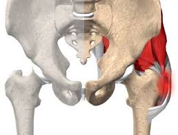 Hip bursitis