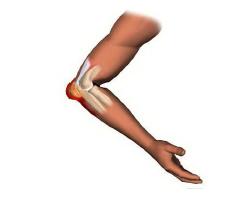 It is an inflammatory process of the bursa located between the olecranon of the ulna and the skin that covers it. The bursa is a shallow, low-pressure sac, susceptible to external pressure.