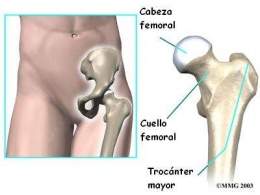It is the inflammation of the serous bursae that are located in the proximal extremity of the femur, it is the most frequent cause of pain from the periarticular structures of the hip.